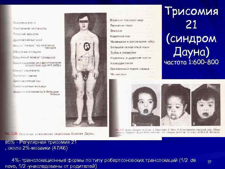 Трисомия 21 (синдром Дауна) частота 1: 600 -800 95% - Регулярная трисомия 21 ,
