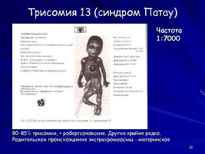 Трисомия 13 (синдром Патау) Частота 1: 7000 80 -85% трисомия, + робертсоновские. Другие крайне