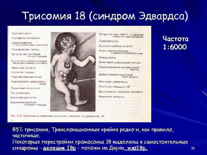 Трисомия 18 (синдром Эдвардса) Частота 1: 6000 85% трисомия, Транслокационные крайне редко и, как