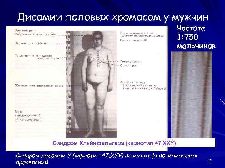 Дисомии половых хромосом у мужчин Частота 1: 750 мальчиков Синдром Клайнфельтера (кариотип 47, XXY)