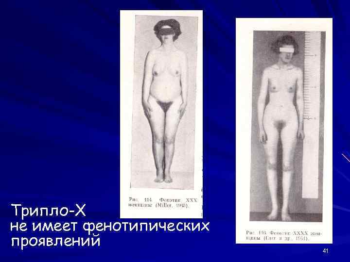 Трипло-Х не имеет фенотипических проявлений 41 