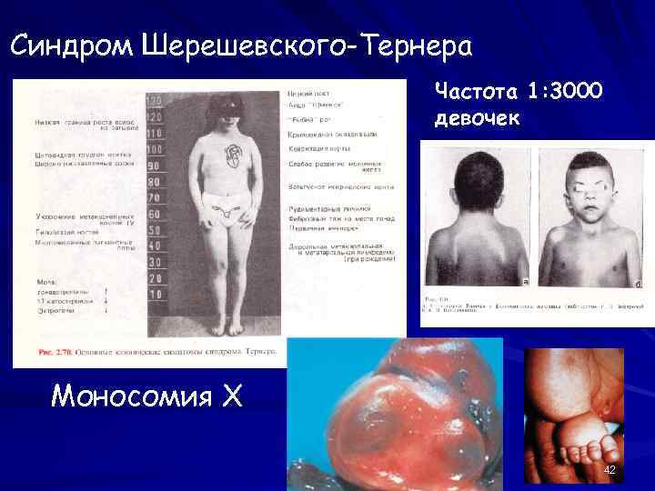 Синдром Шерешевского-Тернера Частота 1: 3000 девочек Моносомия Х 42 