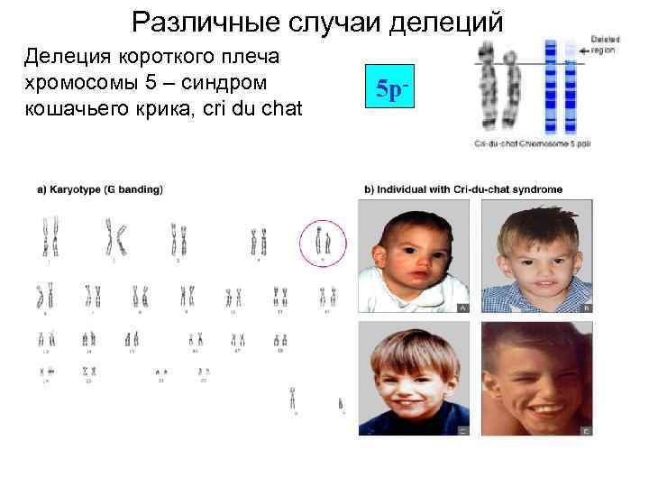 Синдром де груши презентация