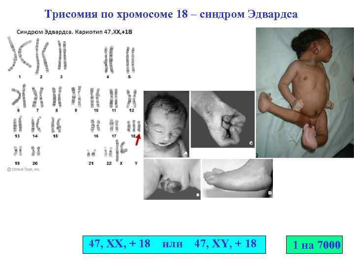 Трисомия по хромосоме 18 – синдром Эдвардса 47, XX, + 18 или 47, XY,