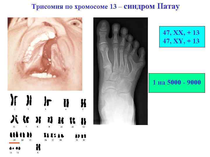 Трисомия по хромосоме 13 – синдром Патау 47, XX, + 13 47, XY, +