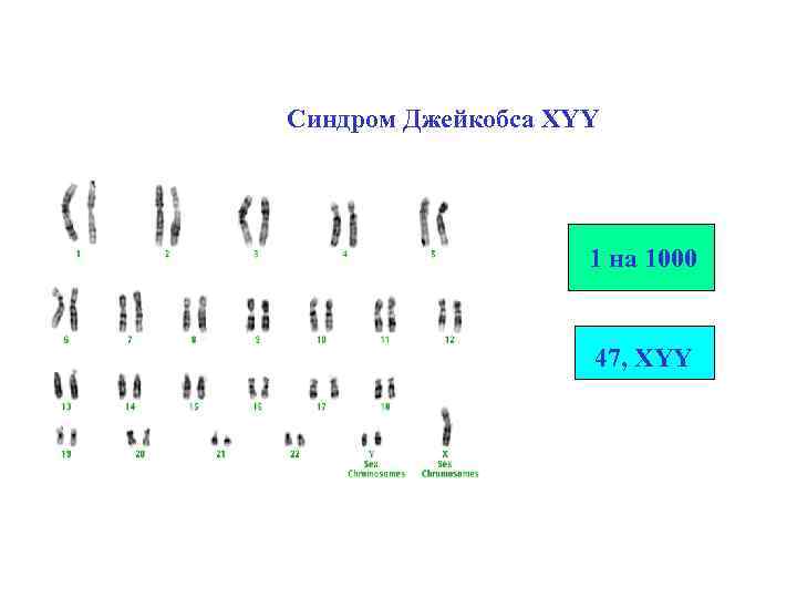 Синдром Джейкобса XYY 1 на 1000 47, XYY 