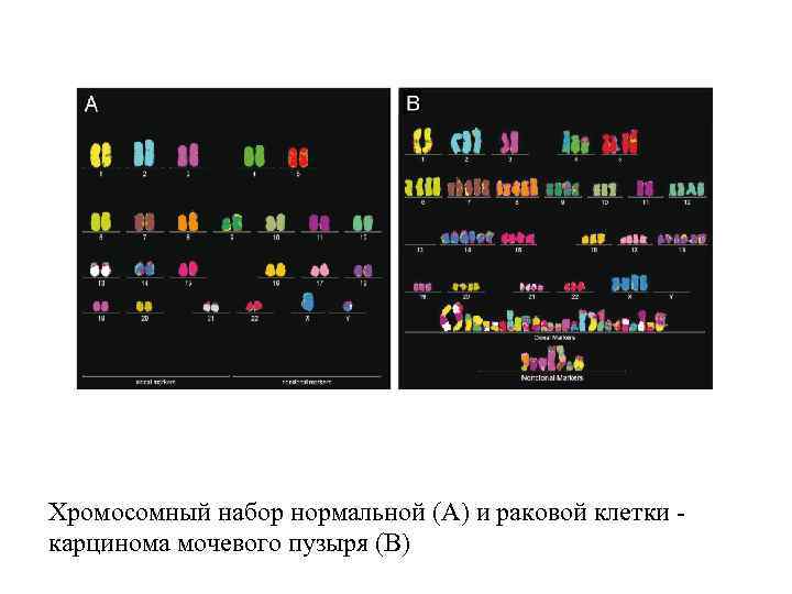 Хромосомный набор нормальной (A) и раковой клетки - карцинома мочевого пузыря (B) 