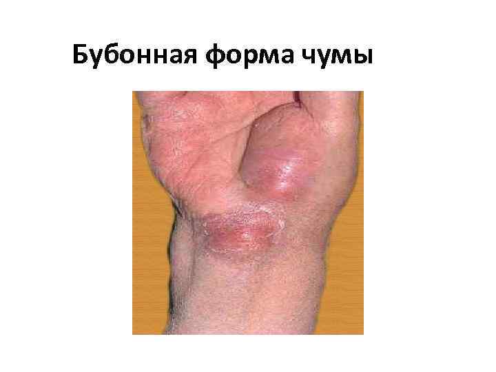 Бубонная форма чумы 