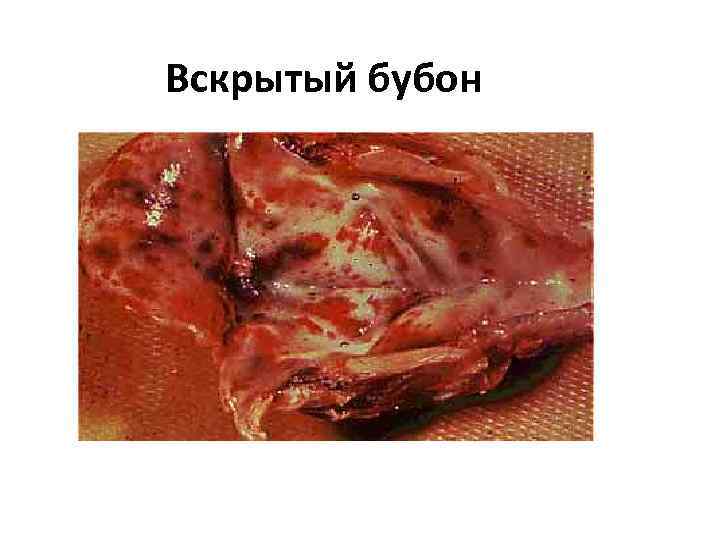 Вскрытый бубон 