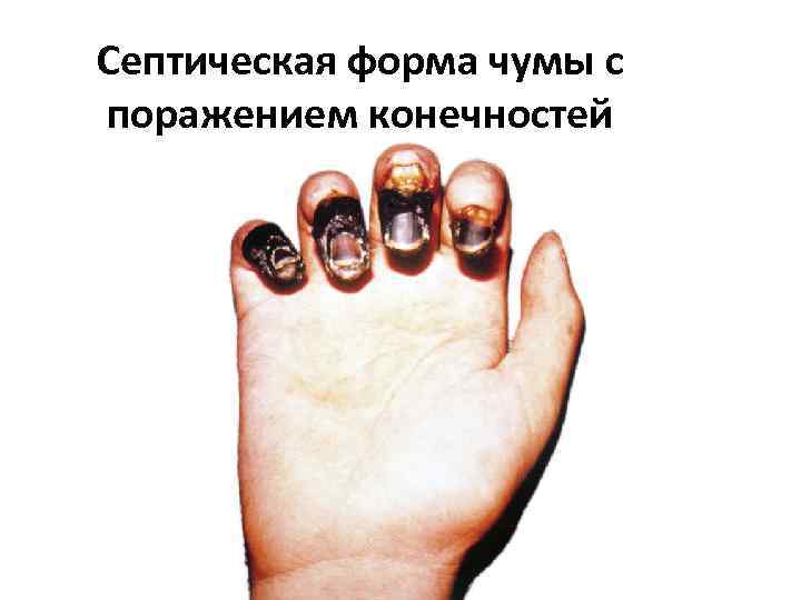 Септическая форма чумы с поражением конечностей 