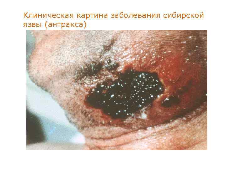 Клиническая картина заболевания сибирской язвы (антракса) 