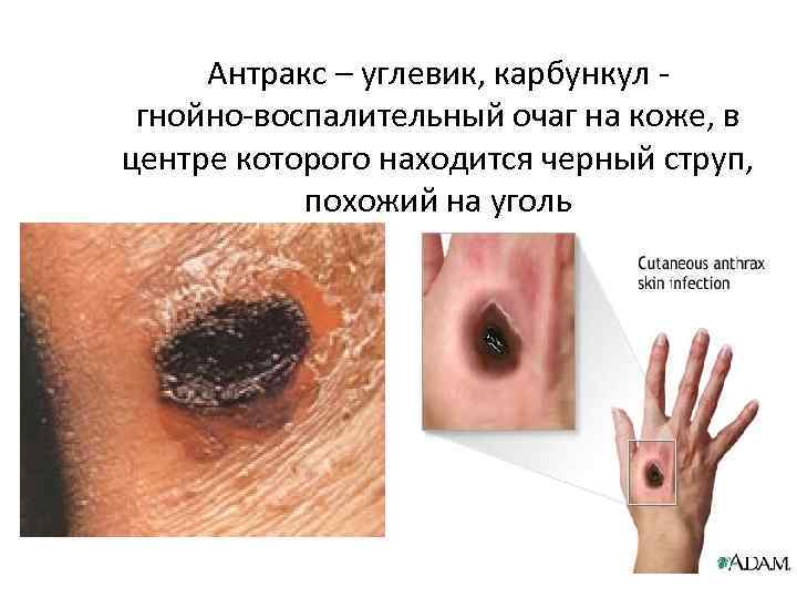 Антракс – углевик, карбункул гнойно-воспалительный очаг на коже, в центре которого находится черный струп,
