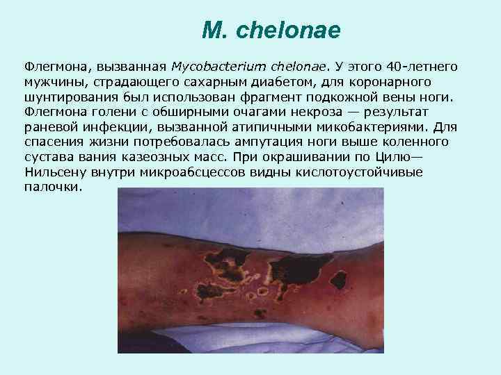 M. chelonae Флегмона, вызванная Mycobacterium chelonae. У этого 40 -летнего мужчины, страдающего сахарным диабетом,