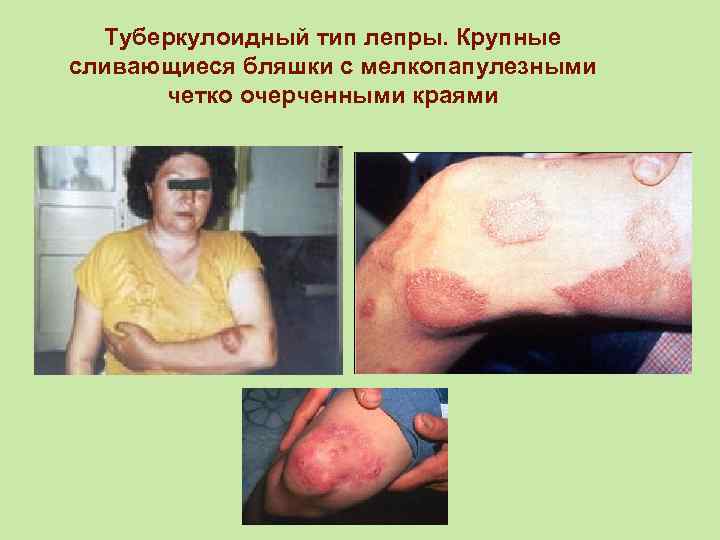 Туберкулоидный тип лепры. Крупные сливающиеся бляшки с мелкопапулезными четко очерченными краями 