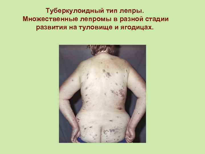 Туберкулоидный тип лепры. Множественные лепромы в разной стадии развития на туловище и ягодицах. 