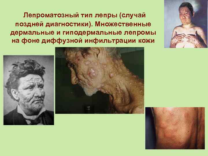 Лепроматозный тип лепры (случай поздней диагностики). Множественные дермальные и гиподермальные лепромы на фоне диффузной