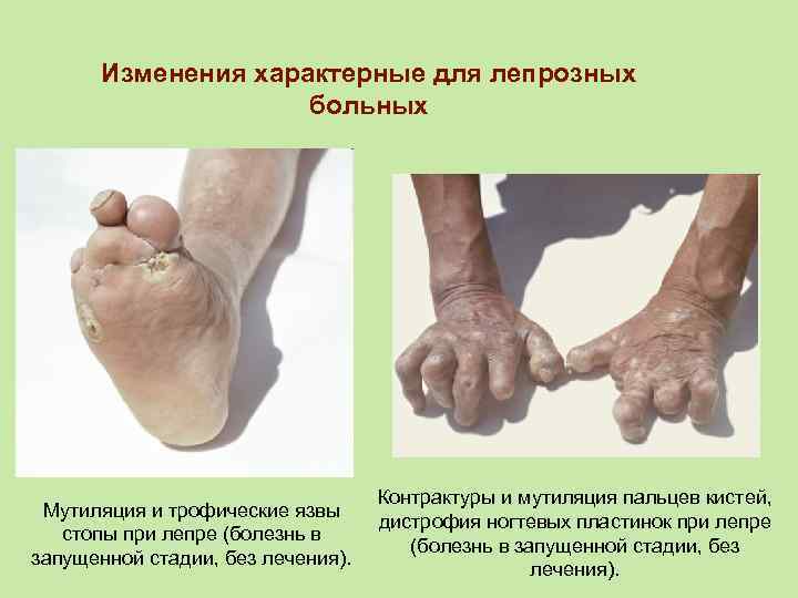 Изменения характерные для лепрозных больных Мутиляция и трофические язвы стопы при лепре (болезнь в