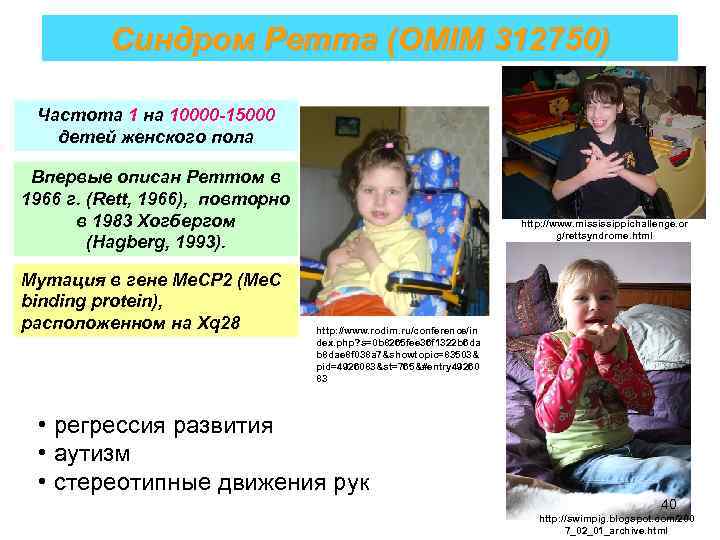 Синдром Ретта (OMIM 312750) Частота 1 на 10000 -15000 детей женского пола Впервые описан