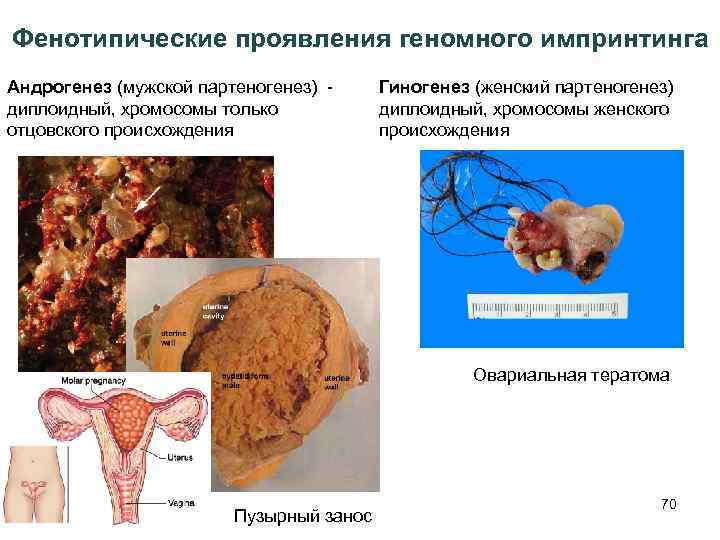 Фенотипические проявления геномного импринтинга Андрогенез (мужской партеногенез) - диплоидный, хромосомы только отцовского происхождения Гиногенез