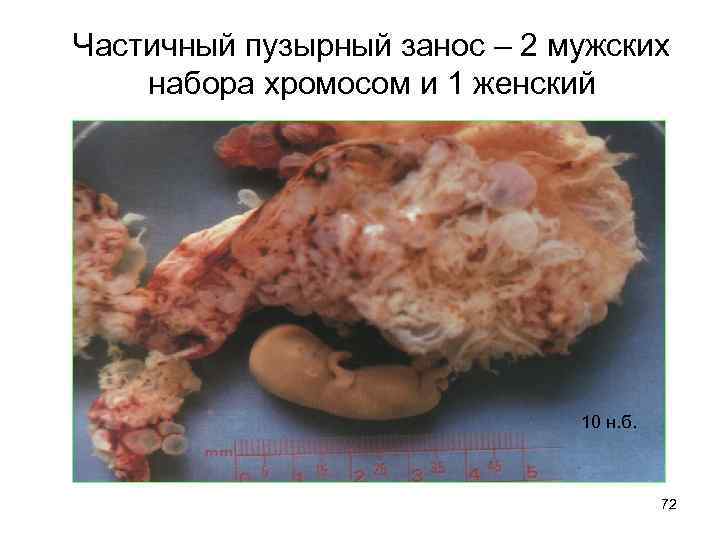 Частичный пузырный занос – 2 мужских набора хромосом и 1 женский 10 н. б.