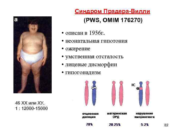 Синдром Прадера-Вилли (PWS, OMIM 176270) • описан в 1956 г. • неонатальная гипотония •