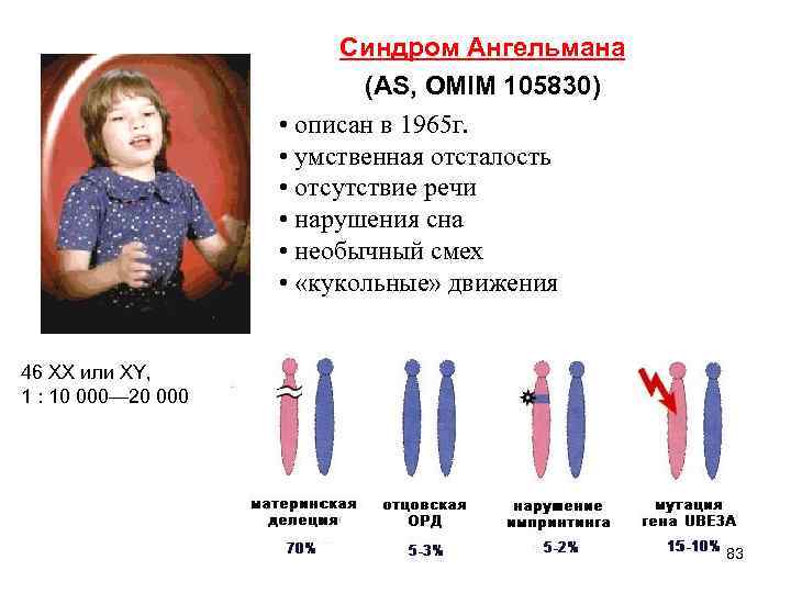 Синдром Ангельмана (AS, OMIM 105830) • описан в 1965 г. • умственная отсталость •