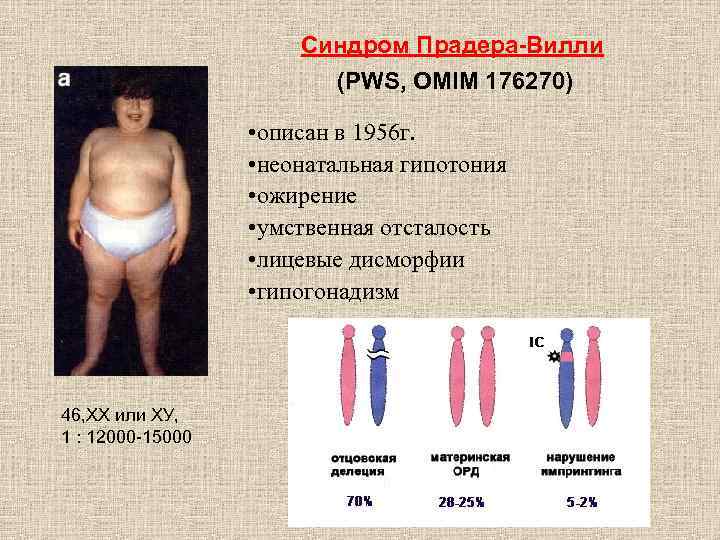 Синдром Прадера-Вилли (PWS, OMIM 176270) • описан в 1956 г. • неонатальная гипотония •