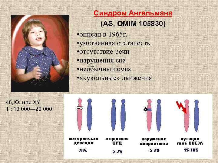 Синдром Ангельмана (AS, OMIM 105830) • описан в 1965 г. • умственная отсталость •