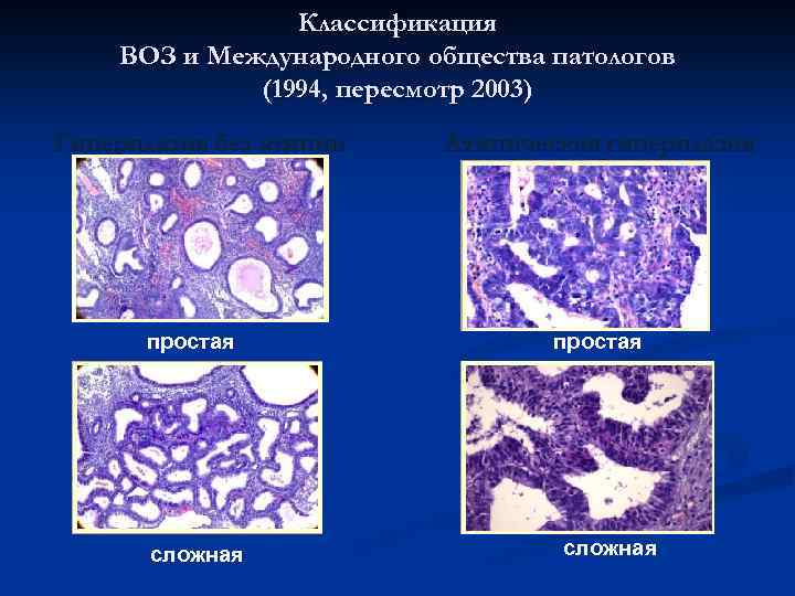 Классификация ВОЗ и Международного общества патологов (1994, пересмотр 2003) Гиперплазия без атипии простая сложная