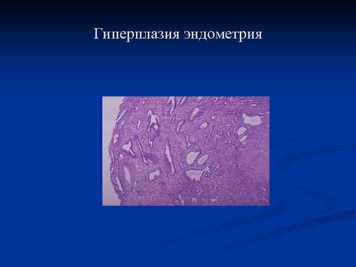 Гиперплазия эндометрия 