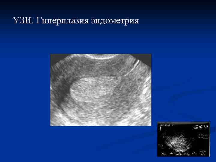 УЗИ. Гиперплазия эндометрия 