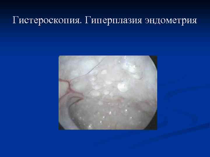 Гистероскопия. Гиперплазия эндометрия 