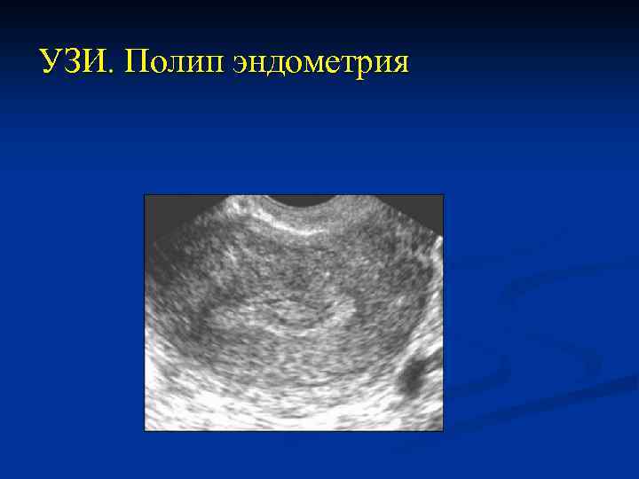 УЗИ. Полип эндометрия 