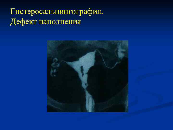 Гистеросальпингография. Дефект наполнения 