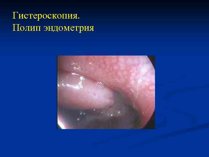 Гистероскопия. Полип эндометрия 