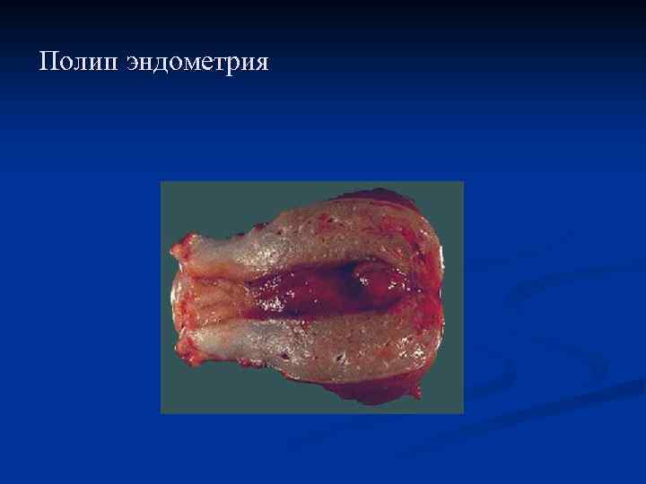 Полип эндометрия 