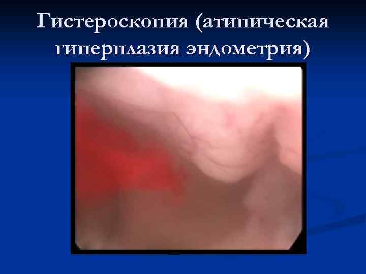 Гистероскопия (атипическая гиперплазия эндометрия) 