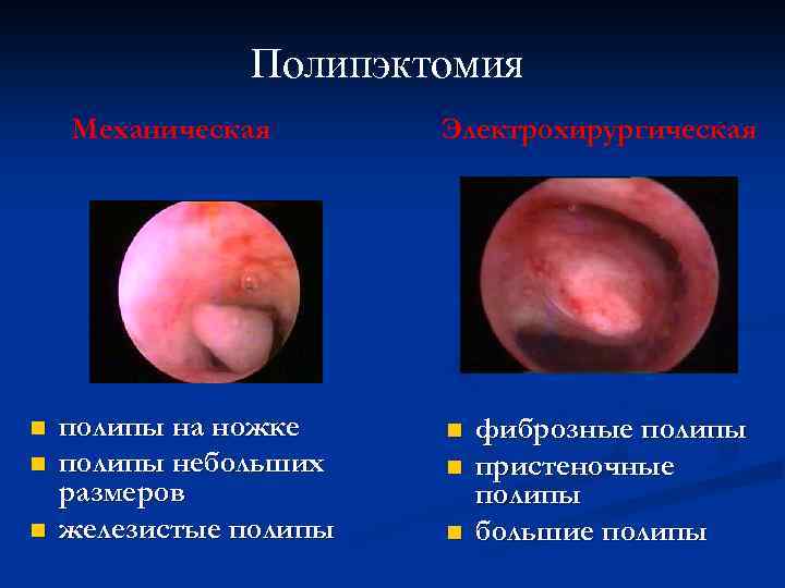 Полипэктомия Механическая n n n полипы на ножке полипы небольших размеров железистые полипы Электрохирургическая