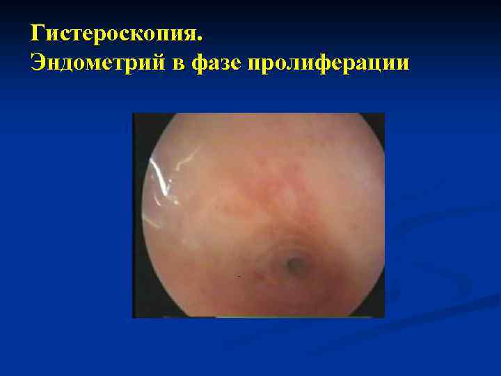 Гистероскопия. Эндометрий в фазе пролиферации 