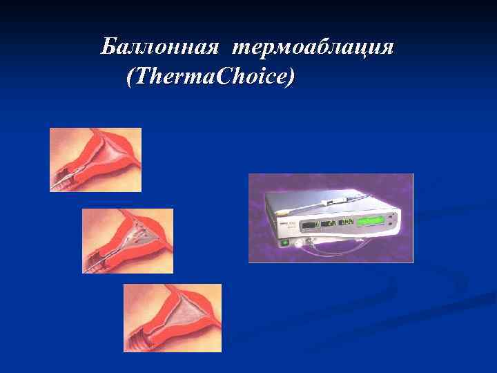 Баллонная термоаблация (Therma. Choice) 