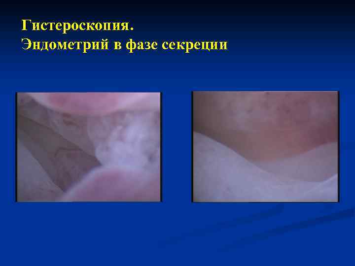Гистероскопия. Эндометрий в фазе секреции 