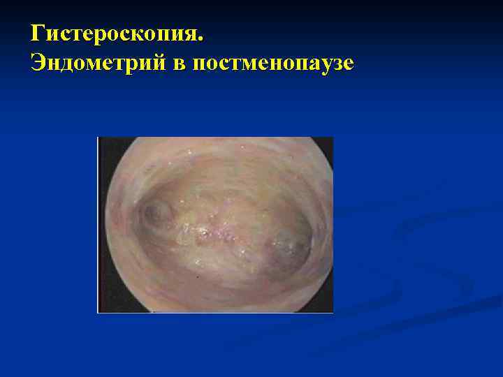 Гистероскопия. Эндометрий в постменопаузе 