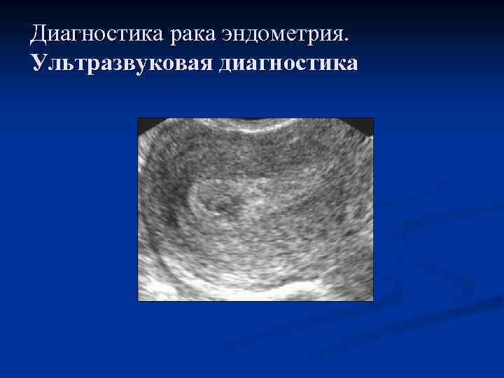 Диагностика рака эндометрия. Ультразвуковая диагностика 