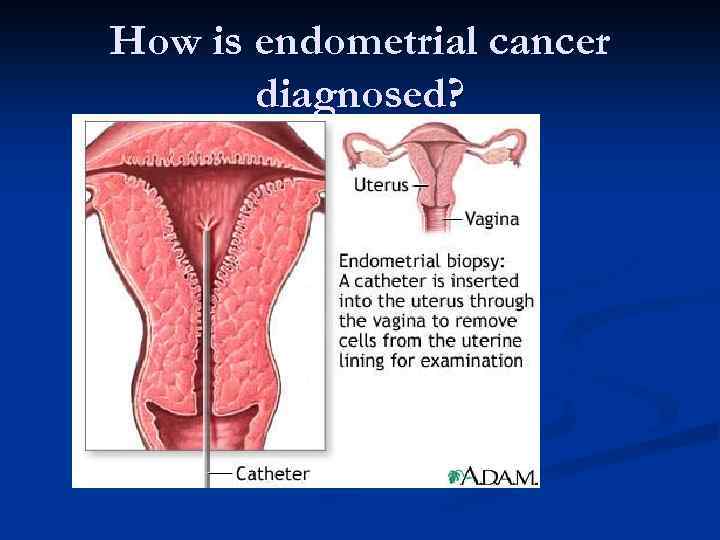 How is endometrial cancer diagnosed? 