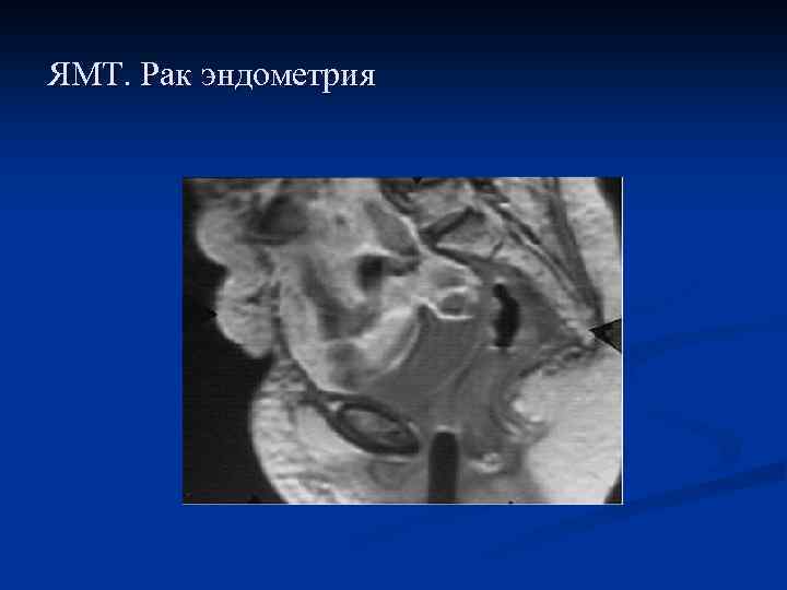 ЯМТ. Рак эндометрия 