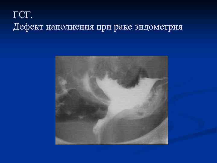 ГСГ. Дефект наполнения при раке эндометрия 