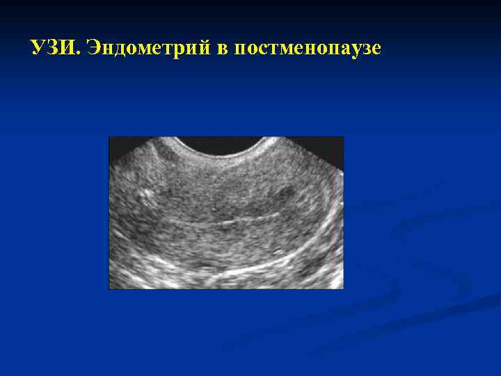 УЗИ. Эндометрий в постменопаузе 