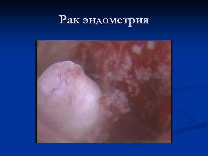 Рак эндометрия 