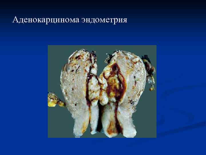 Аденокарцинома эндометрия 