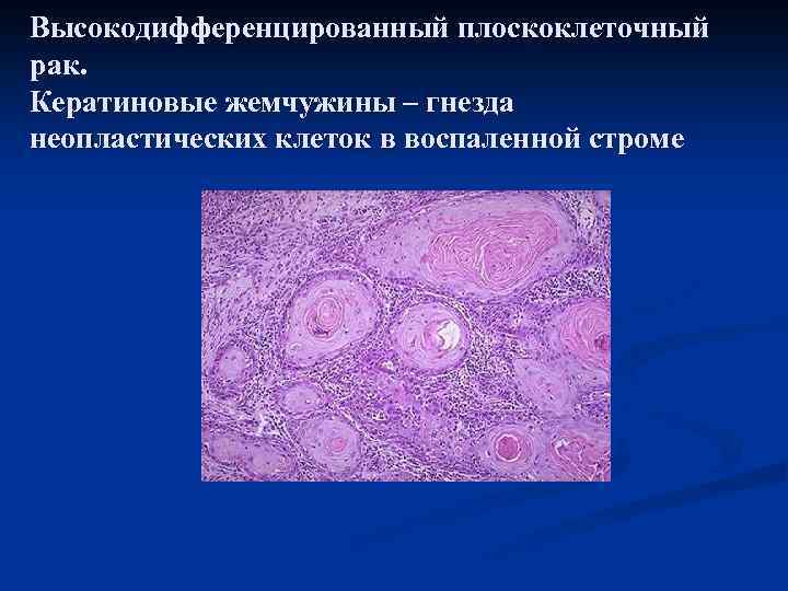 Высокодифференцированный плоскоклеточный рак. Кератиновые жемчужины – гнезда неопластических клеток в воспаленной строме 